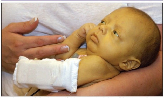 Гемолитическая желтуха у новорожденного 