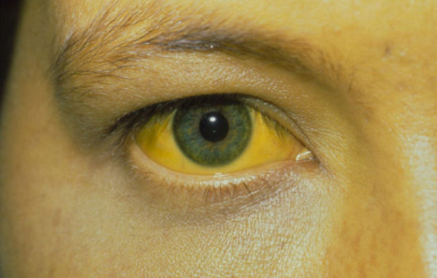 Признак гепатита С - желтоватое окрашивание кожи и слизистых оболочек