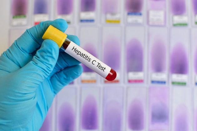 Анализ крови на антитела к гепатиту С