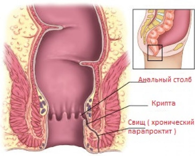 схема развития парапроктита к кишечнике 