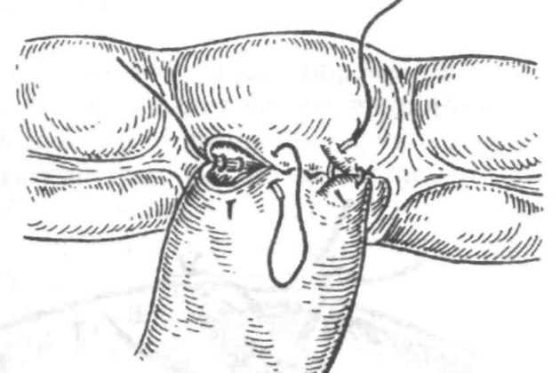 Резекция тонкой кишки с анастомозом «конец в бок»