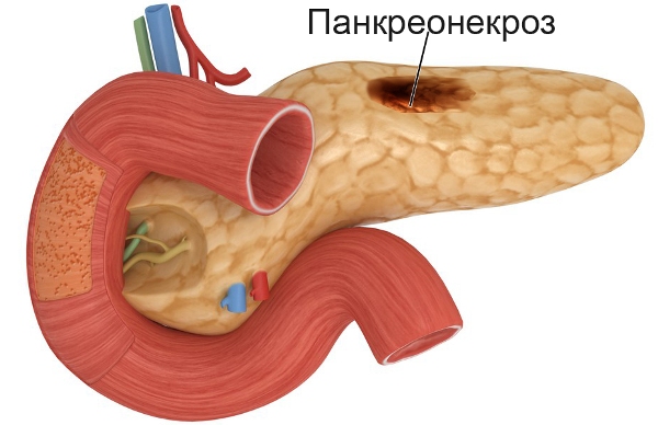 геморрагический панкреонекроз